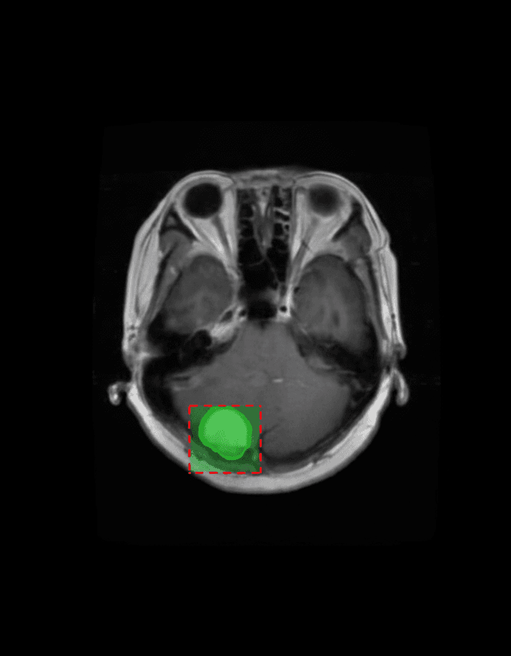 Brain MRI scan with highlighted tumor area